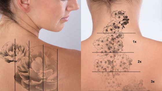 Woman showing stages of tattoo fading on shoulder after removal treatment.