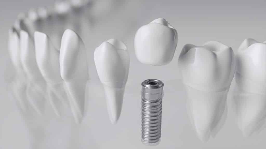 Depositphotos_299845312_XL Dental implant and tooth model, showcasing dental restoration concepts. | Sky Rye Design Dental implant and tooth model, showcasing dental restoration concepts.