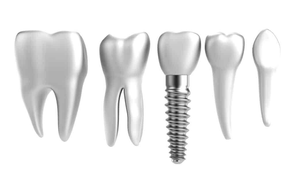 Illustration of dental components: molars, premolars, and a dental implant on a white background.