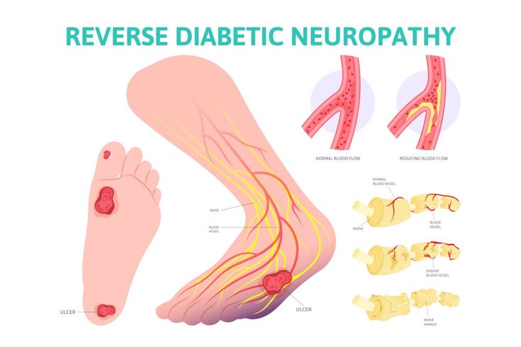 Treatment for Diabetic Neuropathy - The path to reversal Diagram illustrating reverse diabetic neuropathy, showing foot ulcers, nerves, and blood flow for educational purposes. | Sky Rye Design Diagram illustrating reverse diabetic neuropathy, showing foot ulcers, nerves, and blood flow for educational purposes.